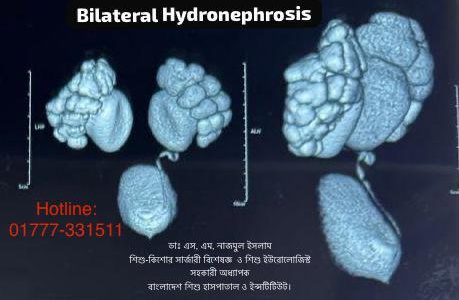 হাইড্রোনেফ্রোসিস