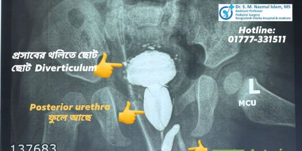 পোস্টেরিয়র ইউরেথ্রাল ভালভ (PUV)Posterior Urethral Valve প্রস্রাবের রাস্তায় পর্দা