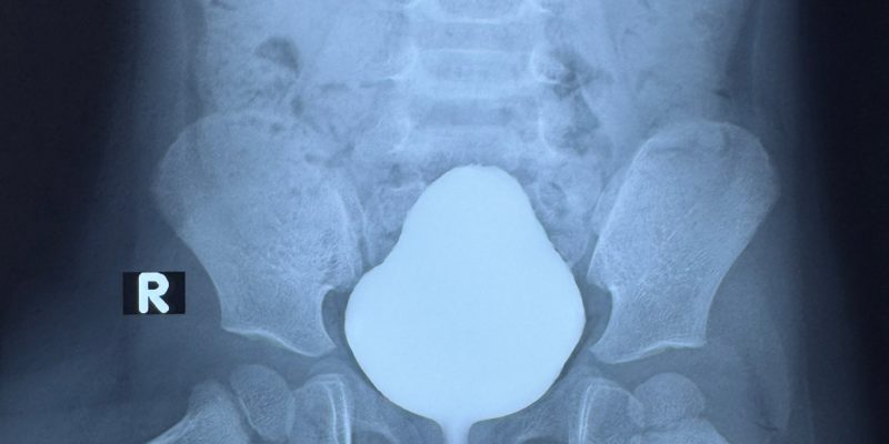 ureteric reflux success operation/ ইউরেটেরিক রিফ্লাক্সে